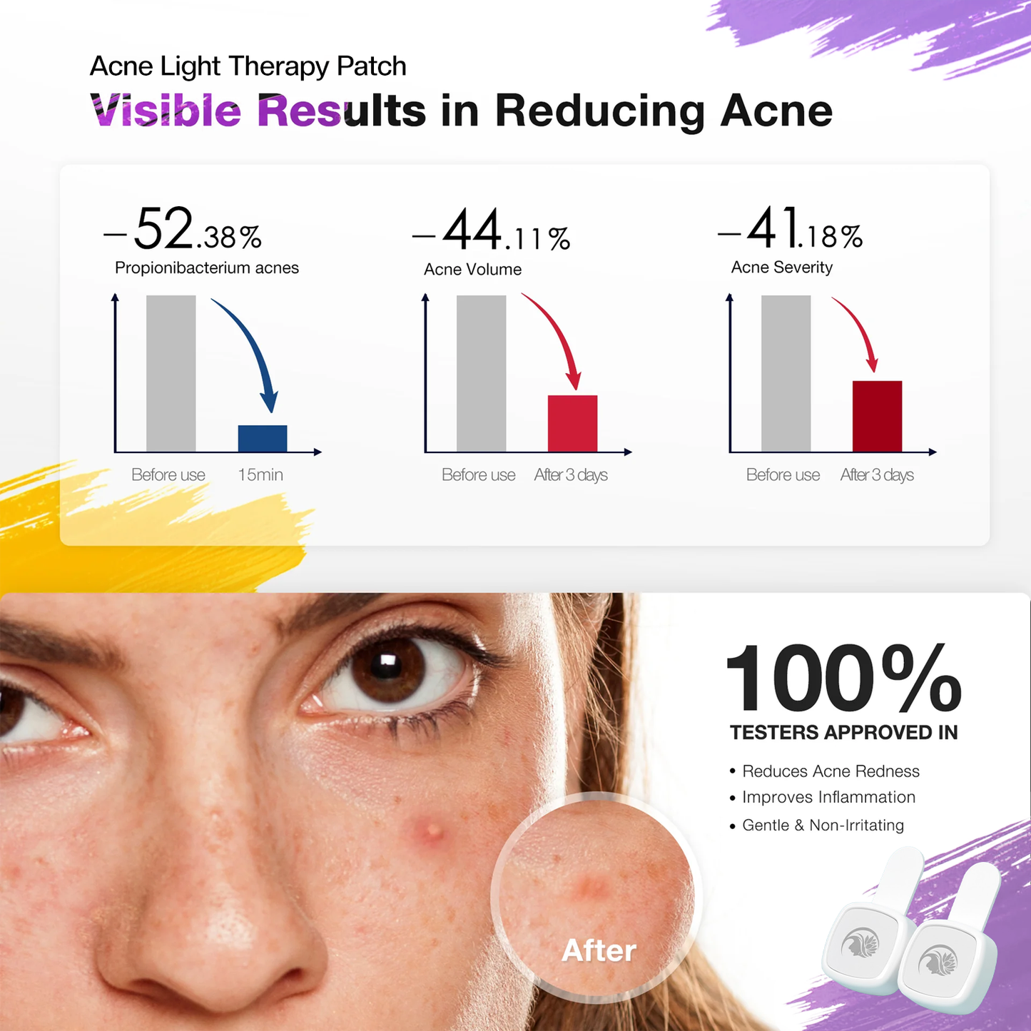 Acne Light Therapy Patch